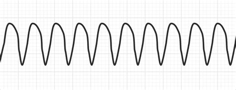 Oceania Indomitable another ventricular tachycardia classification ...