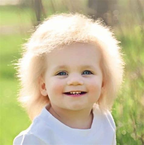 Uncombable hair syndrome causes, symptoms, diagnosis & treatment