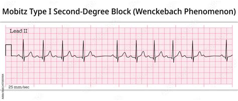 Wenckebach Phenomenon - ECG Mobitz Type 1 Second Degree Atrioventricular Block - 2nd degree AV ...