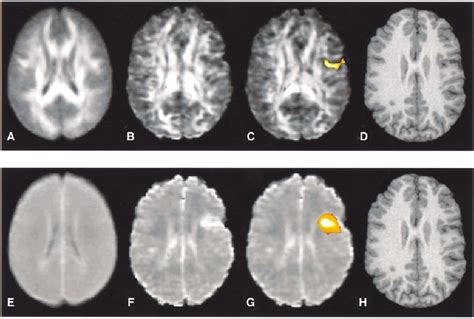 Patient 8, mature cortical infarct in right frontal lobe. ( A – C ...