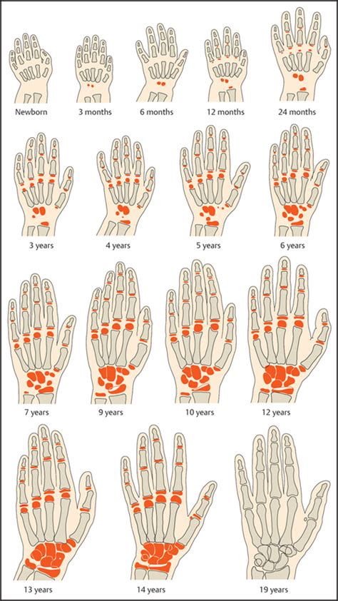 Skeletal Age | Radiology Key