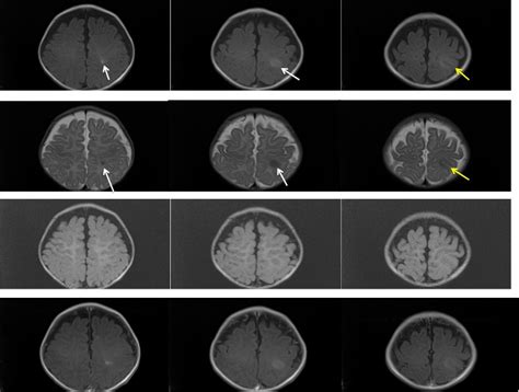 Focal cortical dysplasia – Radiology Cases