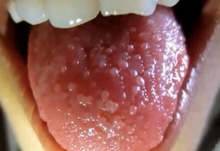 Transient Lingual Papillitis | Medical Point