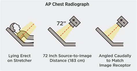 A Full Radiologist Guide on Lordotic Chest X-ray - HSIN FILM