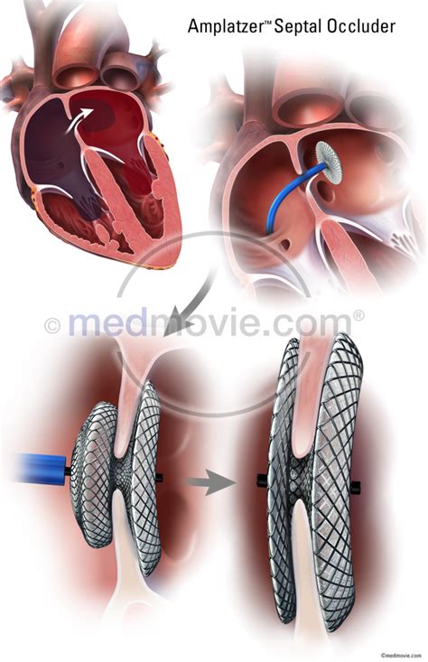 Amplatzer Septal Occluder – Medmovie.com