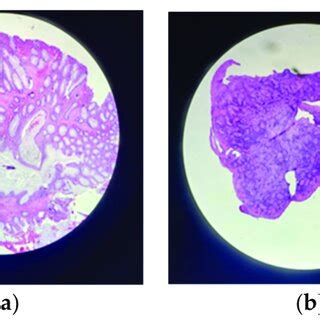 Lower digestive endoscopy: (a) terminal ileum; (b) ileocecal valve; (c)... | Download Scientific ...