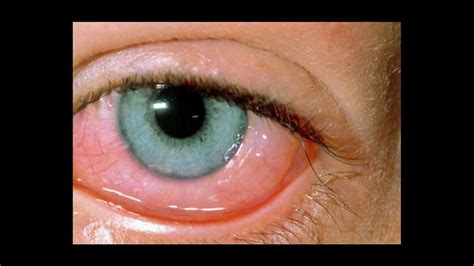 Acute Conjunctivitis - Ophthalmology - Medbullets Step 2/3