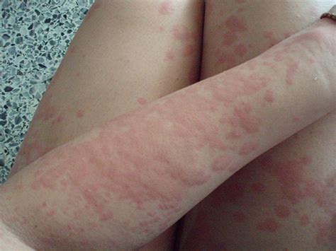 Heat Rash Pictures, Symptoms, Heat Rash Treatment