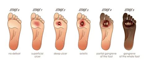 Diabetic Foot Ulcer, Advanced Diabetic Foot Care, University Foot and ...