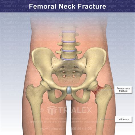 Femoral Neck Fracture - TrialQuest Inc.