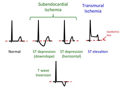 treatment_of_angina [TUSOM | Pharmwiki]