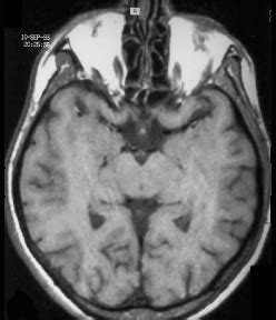 Neuropsychology of Congenitally Blind Learners: Recognition Networks