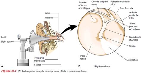 Tympanosclerosis – Oto Surgery Atlas, 53% OFF