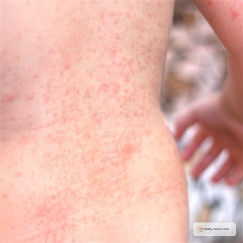 Natural Remedies for Heat Rash in Children