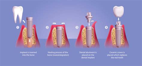 Dental Implants Side Effects - Tarzana Dentist | Victory Cosmetic Dentistry