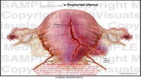 Rupture of the uterus