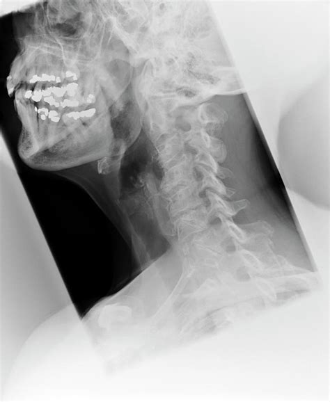 Osteoarthritis Of The Neck Photograph by Dr P. Marazzi/science Photo Library