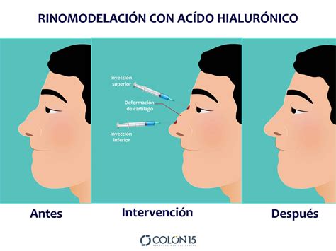 Rinomodelación con ácido hialurónico - Colón15 Sevilla - Centro Médico ...