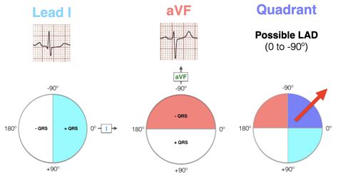 Ecg Axis Interpretation Litfl Ecg Library Basics | Hot Sex Picture