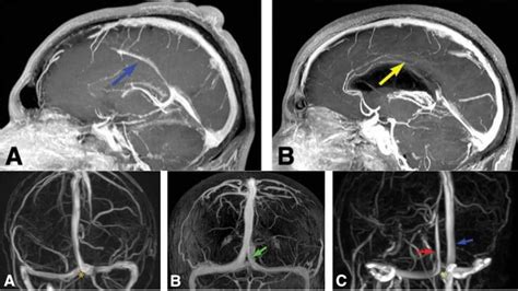 Dural Venous Sinuses Radiology