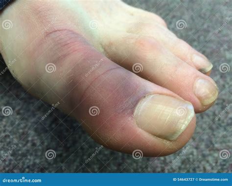 Bruised Big Toe- Male. Stock Photo - Image: 54643727