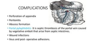 Appendicitis | PPT