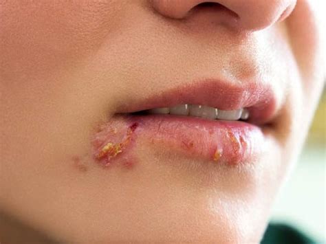 Shingles on the lips should be treated like? | Vinmec