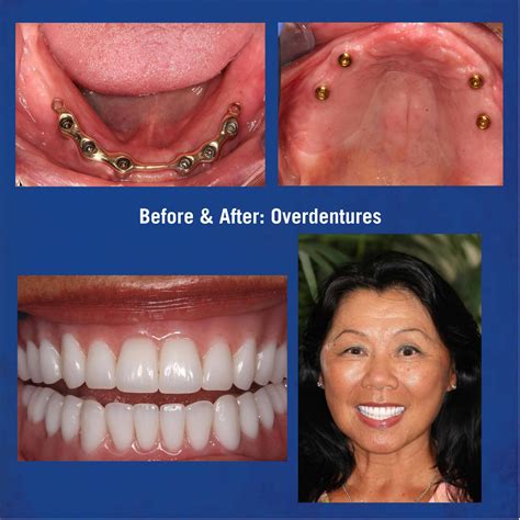 Implant Supported Over-Dentures & Hybrids Wellington FL, Wellington Center for Laser Dentistry