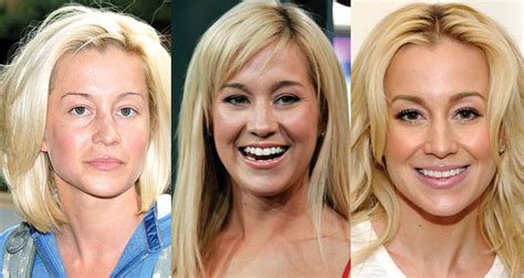 Kellie Pickler Plastic Surgery Before and After Pictures 2024