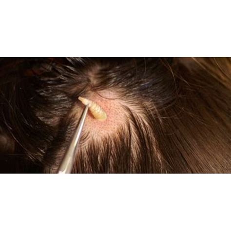 Bot fly removal from a man's scalp. | Adrian Resendez | Flickr