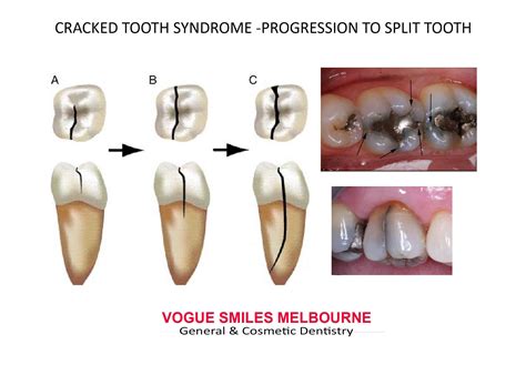 Cracked tooth, Cracked tooth syndrome