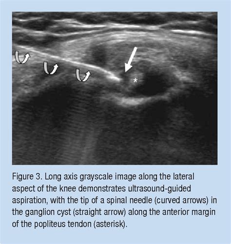 Ganglion Cyst Aspiration