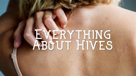 What Causes Hives and How to Treat Them | HubPages