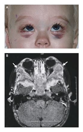 Blueberry muffin baby: A pictoral differential diagnosis