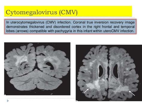 imaging of viral encephalitis