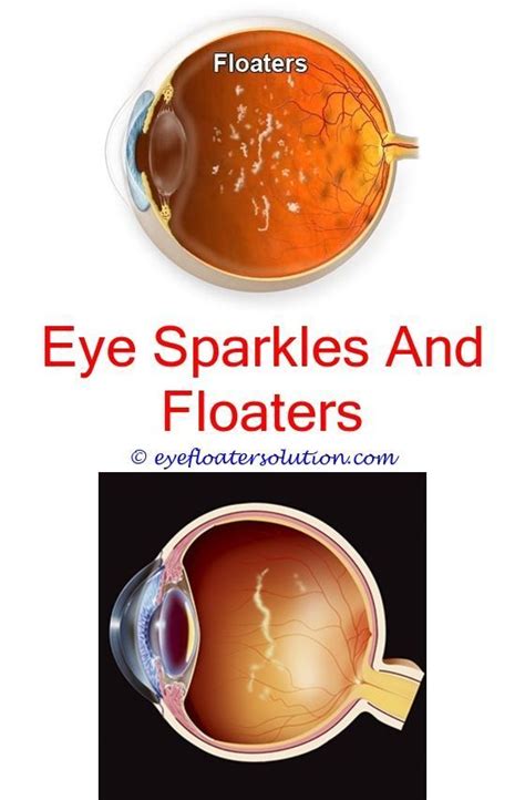 floaters black spot in eye - constant headaches and eye floaters.glitter floaters in eye eye ...