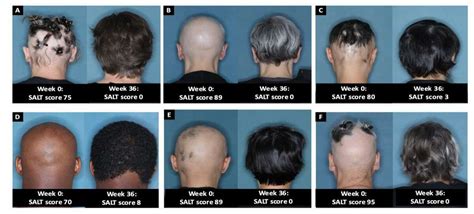 Yale doc at center of push for new alopecia areata drug sees vindication in FDA approval