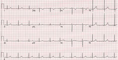 Learn the 8 Steps to Read a Heart Monitor | Just-Health.net