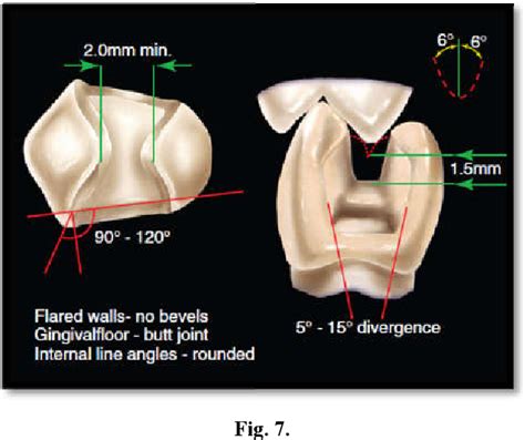 Figure 4 from ONLAY PREPARATION TECHNIQUES | Semantic Scholar