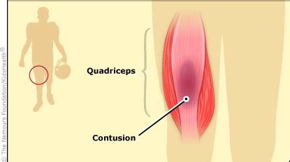 Quadriceps Contusion (for Teens) - Rady Children's Hospital (XML)