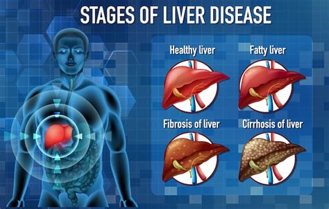 Free Vector | Stages of liver disease