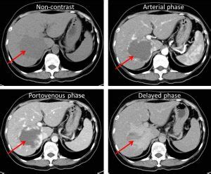 Hepatic venous malformation (hemangioma) – Radiology Cases