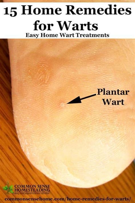 Pin on Plantar Warts