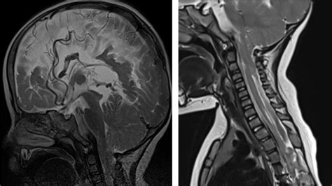 Partial agenesis of corpus callosum – Radiology Cases