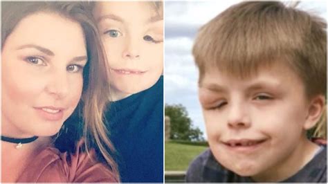 Mother Of Boy With "Elephant Man" Disease Reveals Her Son Feels Isolated