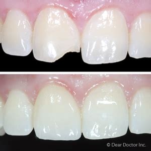 Bonding with Composite Resins Ideal for Restoring Chipped Teeth