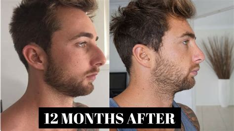 Male Before & After Rhinoplasty, Nose Job 1 year post Operation, 1 year after - YouTube