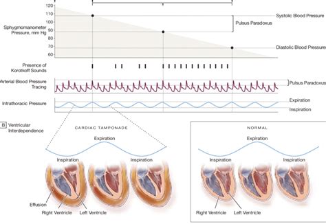 Measurement and Mechanism of Pulsus Paradoxus | Download Scientific Diagram