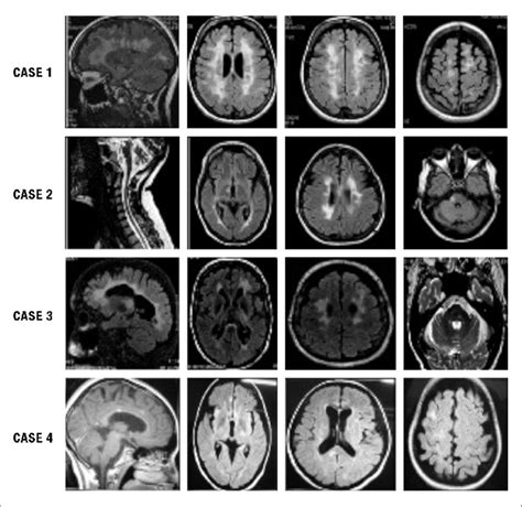 Ms Mri Brain Scan Results