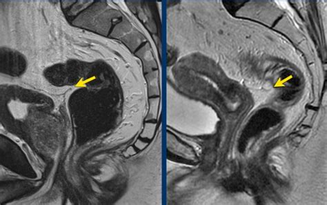 The Radiology Assistant : Rectal Cancer MR staging 3.0